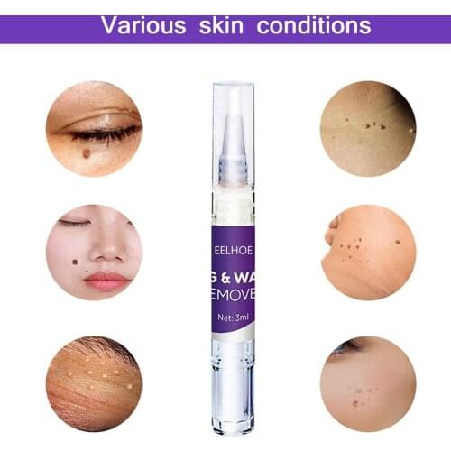 3ml Removal Of Warts Liquid From Skin Tags Removing Against Wart Corn Remove Skin Label Degreasing Pen
