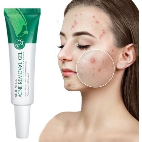 Natural Aloe Vera Gel Anti Moisturizing Acne Treatment Anti-inflammatory Damage Skin Bites Care Repair Skin Face Cream