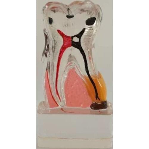 4 Times periodontal Disease Teeth Model