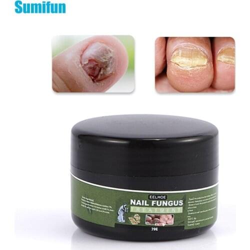 1pcs Fungal Nail Treatment Cream Toenails FingernailsNail Repair Antibacterial Cream Gray Nails PChinese Herbal Ointment 0232