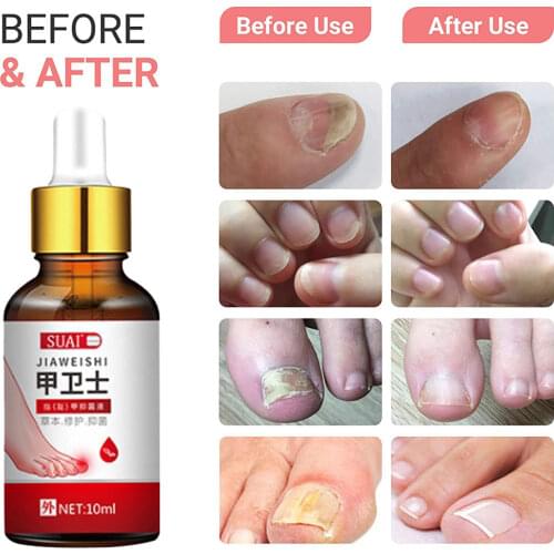 Nail Fungal Treatment Feet Care Essence Nail Foot Whitening Toenail Fungus Removal Gel Anti Infection Paronychia Onychomycosis