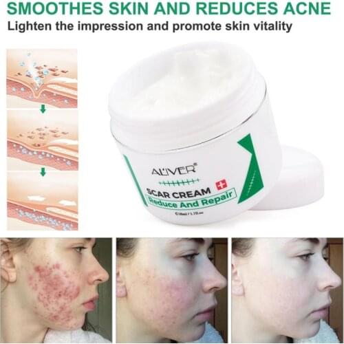 Acne Scar Removal Cream Gel Face Body Skin Repair Cream Scar Removal Cream For Old Scars Stretch Mark Body Cream Skin Care TSLM1