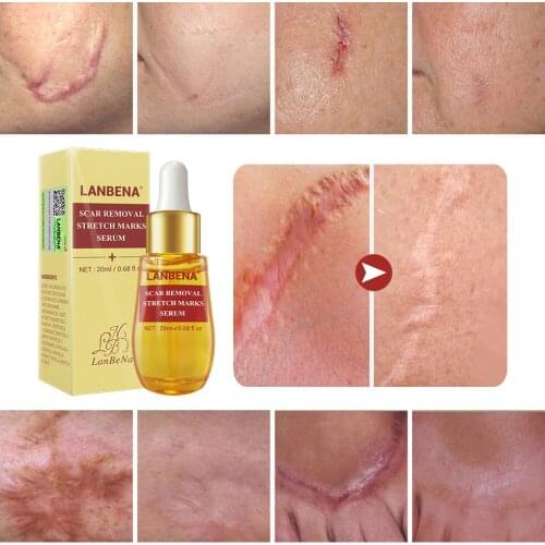 LANBENA Acne Scar Remove Serum Acne Treatment Remover Stretch Marks Anti Acne Shrink Pores Blackhead Whitening Cream Skin Care