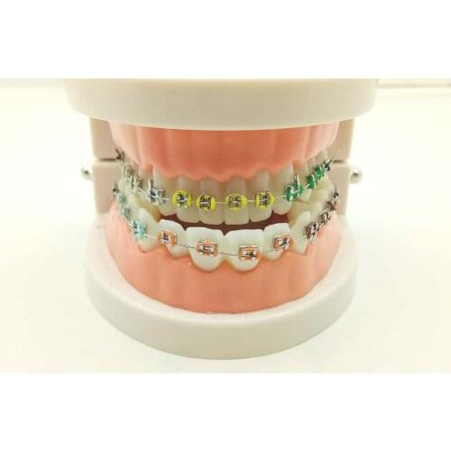 Dental Orthodontic Treatment Model With Ortho Metal Ceramic Bracket Arch Wire Buccal Tube Ligature Ties
