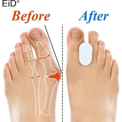 EiD 2Pcs Silicone Toe Separator Bunion Splint Hallux Valgus Orthosis Correction Overlapping Spreader Foot Protector Inserts
