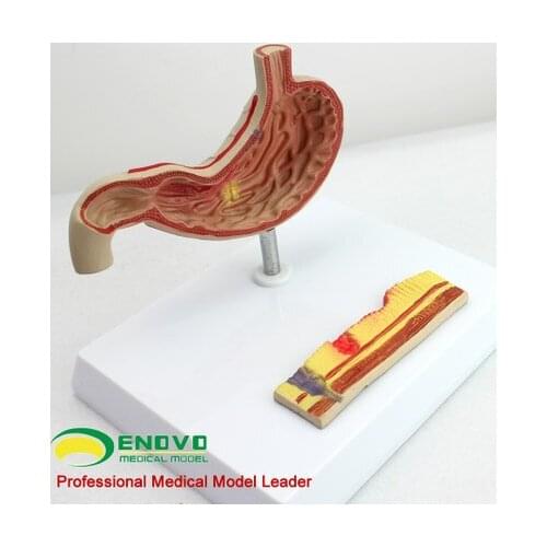 Model of gastric ulcer : digestive system model