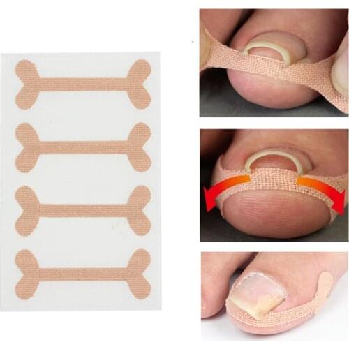 New ingrown toenails band Aid relief pain Paronychia correction pedicure Elastic Force Sticker Repair bandage toe nail care