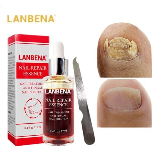 LANBENA Fungal Nail Repair Essence Serum Care Treatment Foot Nail Fungus Removal Gel Anti Infection Paronychia Onychomycosis