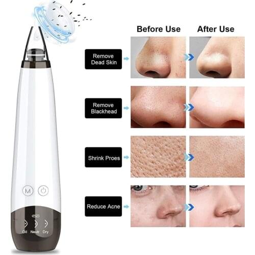 Electric Vacuum Suction Blackhead Remover Facial Nose Cleansing Tool Acne Pimple Removal Pore Spot Cleaner Skin Care Tool