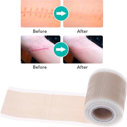 4M/Roll Reusable Silicone Gel Efficient Beauty Scar Removal Self-Adhesive Silicone Gel Tape Patch For Acne Burn Scar Reduce