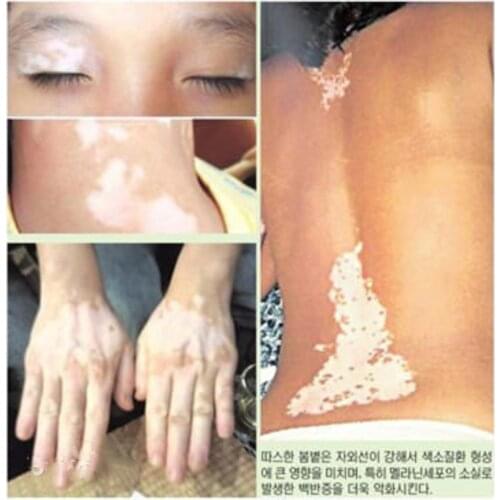 Vitiligo topical melanin repair white spot cover liquid waterproof special effect concealer treatment white epilepsy