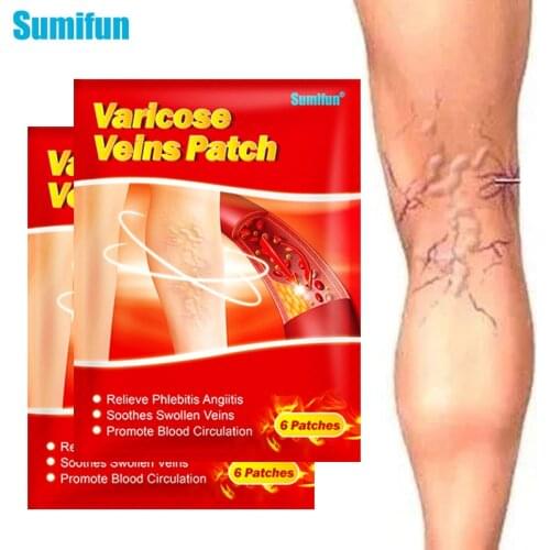 Sumifun 6/12Pcs Varicose Veins Treatment Blood Vessel Swelling Itching Leg Numbness Vasculitis Phlebitis Angiitis Plaster Patch