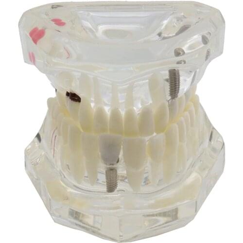 Dental Teeth Model Implant and Restoration Model Transparent Study Analysis Demonstration Teeth Model With Restoration Bridge