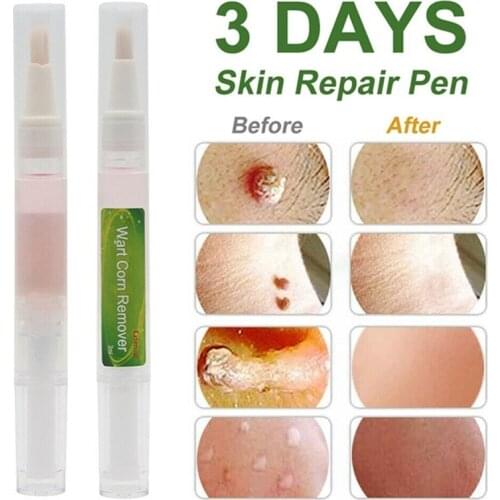 3 Days Skin Tag Remover Pen Wart Removal Pen Tag Removal Freckle Wart Dark Spot Remover Blackhead Removers Skin Care Tool