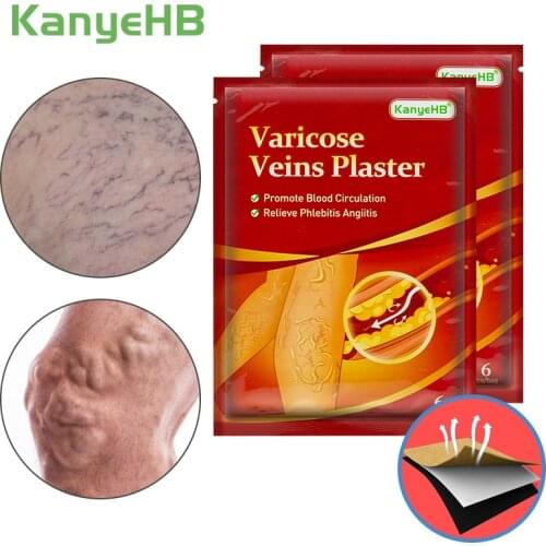 12pcs/2bags Powerful Varicose Veins Plaster Vasculitis Phlebitis Patch Varicosity Angiitis Removal Herbal Medical Plaster A593