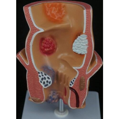 Anatomical Human Rectum Pathology Lesion Model Hemorrhoids Anus Medical Teaching Rectal Learning Teaching Resources