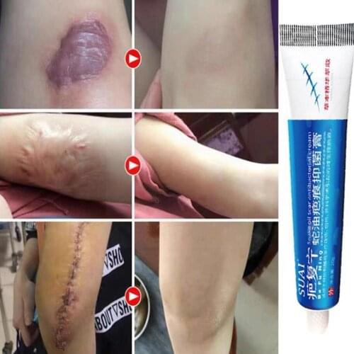 20g Acne Surgery Scar Repair Patch Acne Stretch Mark Acne Skin Whitening Body Remove Smoothing Moisturizing Gel To Care U1g1