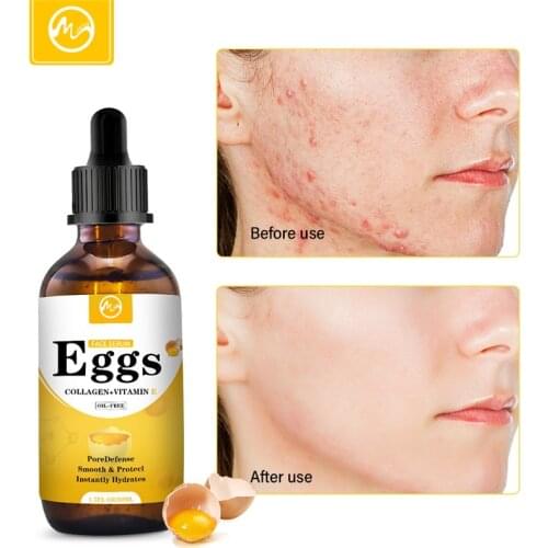 Minch Blackhead Remove Face Serum Egg Essence Pore Minimizer Oil Control Shrink Pores Serum Skin Care Oil Korea Whitening Serum