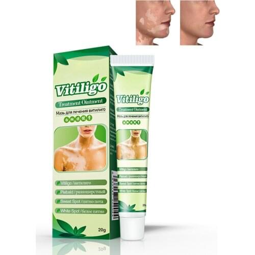 Sumifun New Vitiligo Leukoplakia Disease Treatment Ointment White Spot Disease Repair Cream Chinese Medical Pigment Melanin Balm