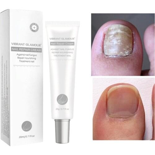 20g Toenail Care Repair Cream Anti Fungus Nail Toe Antifungal Onychomycosis Repairing Promote Nail Growth Brighten Nail