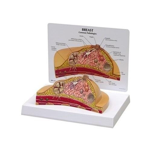 Full size cross-section breast structure model depicts common pathologies breast model