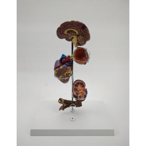 Free shipping&Hypertensive lesion model, school teaching model