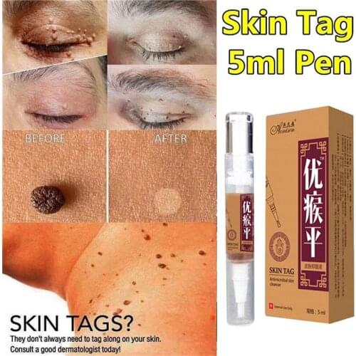 Skin Tag Remover Medical kill Remover Skin Tag Mole & Genital Wart Remover Foot Corn Foot Patch Removal Tool 5ml Skin Care