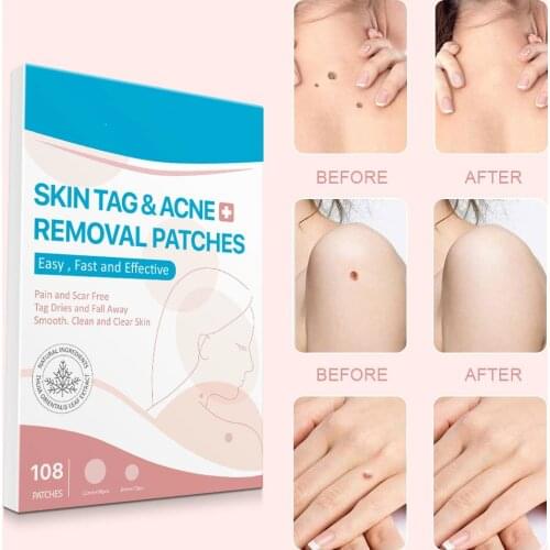 108 Patches Wart Removal Stickers With 1pcs Wart Removal Pen Set Skin Tag Remover Patch Face Acne Pimple Hydrocolloid Master