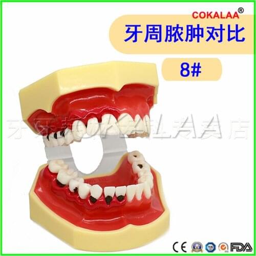 Good quality Swollen gums model Doctor-patient communication dentures teeth model for dentists learning