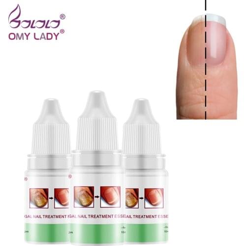 OMY LADY 3pcs Fungal Nail Treatment Essence and Foot Whitening Toe Fungus Removal Gel Anti Infection Paronychia Onychomycosis