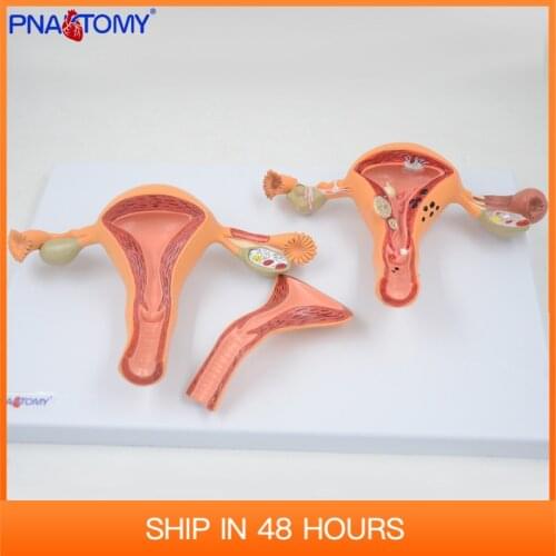 Medical props model human Pathological Uterus Ovary Model Detachable Normal Anatomical Teaching Tool Gift