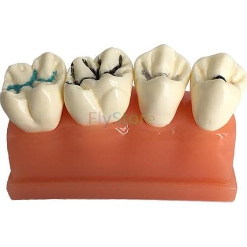 1Pc Dental Pit and Fissure Sealing Treatment Teeth Tooth Study Learn Model For Dental Lab