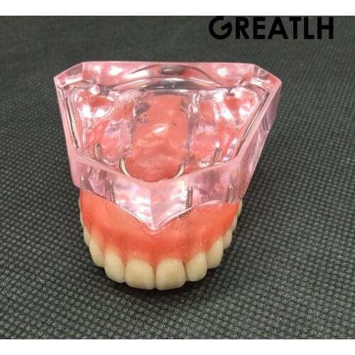 Dental Overdenture Superior with 4 Implants Demo Model Dental Teaching Study Demonstrate Model #6001 01
