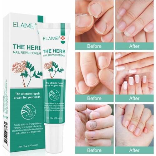 Nail Care Cream Nail Repair Liquid Onychomycosis Nutrition Cream Foot Nail Fungus Removal Nail Care TSLM1