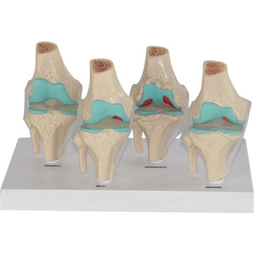 Knee joint model knee joint pathological model
