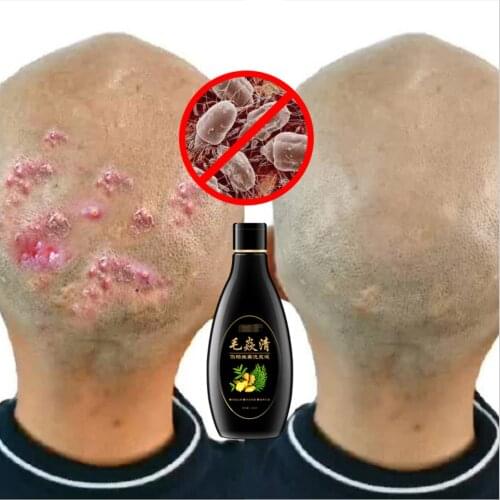 Scalp Hair Follicle Shampoo Antibacterial Anti-itching Mites Oil Control Psoriasis and Scalp Cleansing Shampoo Skincare Product