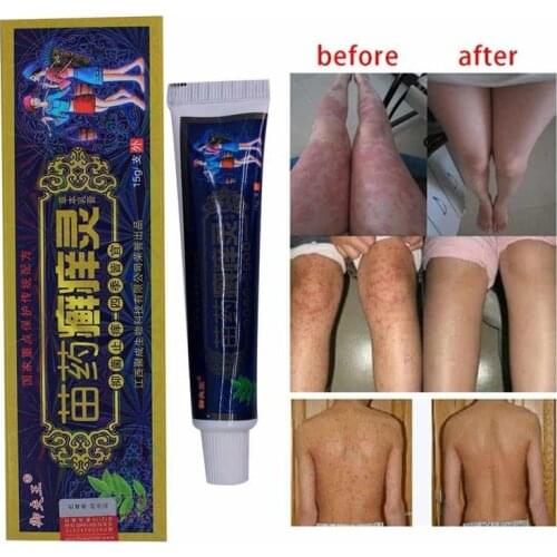 Bacteriostatic Psoriasis Cream Dermatitis Eczematoid Eczema Ointment Treatment Psoriasis itching Cream Skin Care Body cream