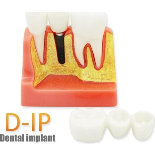 D-IP Dental Materials Lab Teeth Model 6 Times Caries Comparation Study Models For Dentist Studying and Researching
