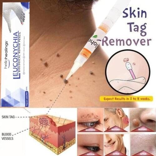 Skin Tag Remover Medical Against Moles Fast Removal Genital Wart Acne Spot Treatment Anti Foot Corn Skin Care Liquid 3ml