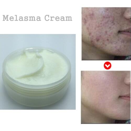 Melasma Cream Removal Freckle Speckle Age Spots Sunburn Acne Scar Whiten Cream face cream 30grams