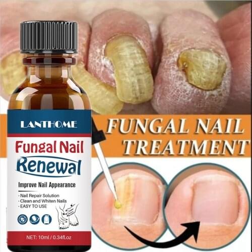 Herbal Fungal Nail Treatment Essential oil Hand and Foot Whitening Toe Nail Fungus Removal Infection Feet Care Polish Nail Gel