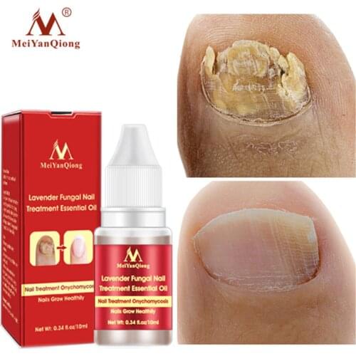 Fungal Nail Treatment Serum Onychomycosis Paronychia Anti-Fungal Nail Infection Herbal Toe Fungus Foot Repair Essence Care 10ml