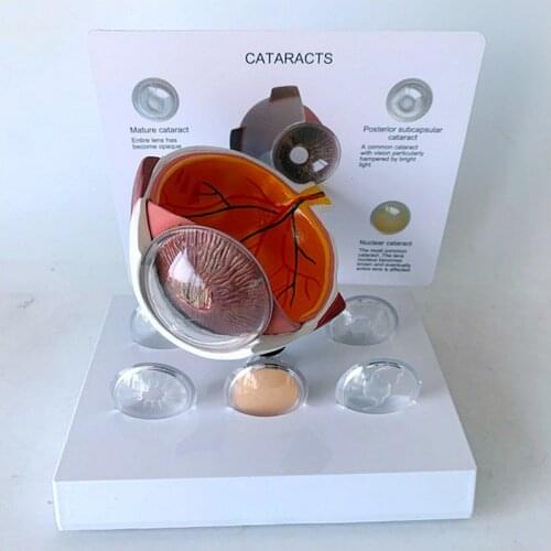 Human eye model eyeball cataract eye disease pupil eyeball body eyeball sperm body medical teaching aids