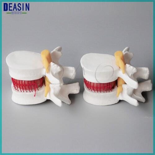 Spine Lumbar Disc Herniation model