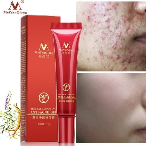 Effective Acne Removal Cream Herbal Anti-acne Repair Fade Acne Marks Spots Oil Control Whitening Moisturizing Face Gel Skin Care