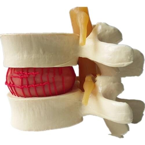 Lumbar Enlarged Lumbar Disc Herniation Demo Model Vertebrae Pathology Demo Model Spine Model