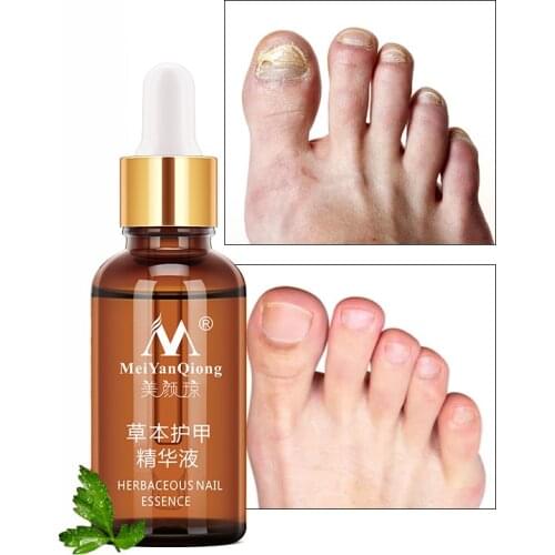 Nail Fungal Treatment Feet Care Essence Nail Foot Whitening Toe Nail Fungus Removal Gel Anti Infection Paronychia Onychomycosis