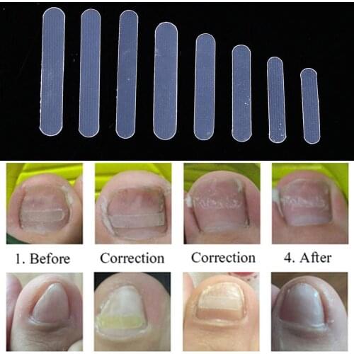 100pcs/box Toe Nail Sticker Brace Toe Thick Correction Patch Foot Care Tools Ultra-thin Transparent Rod Design Invisible