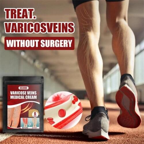 Gecorid Cream For Varicose Veins