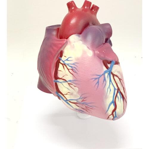 Human Atherosclerosis Thrombosis Heart Disease Model Anatomy Heart Structure Internal Pathology Visceral Heart Valve
